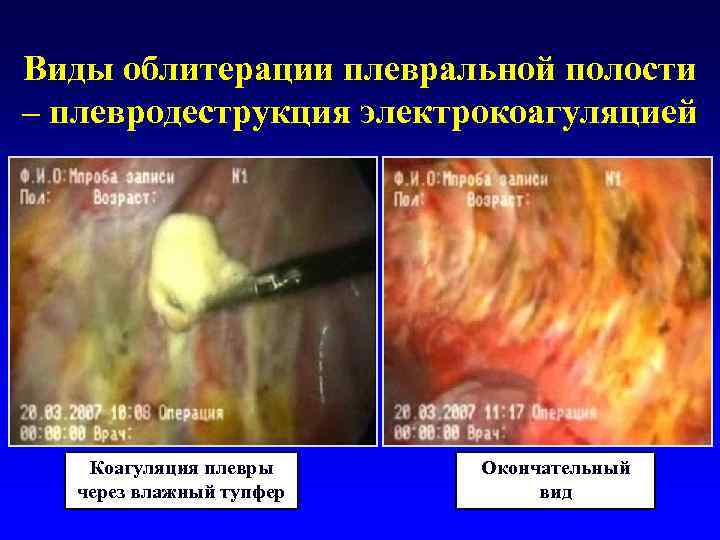 Виды облитерации плевральной полости – плевродеструкция электрокоагуляцией  Коагуляция плевры Окончательный  через влажный