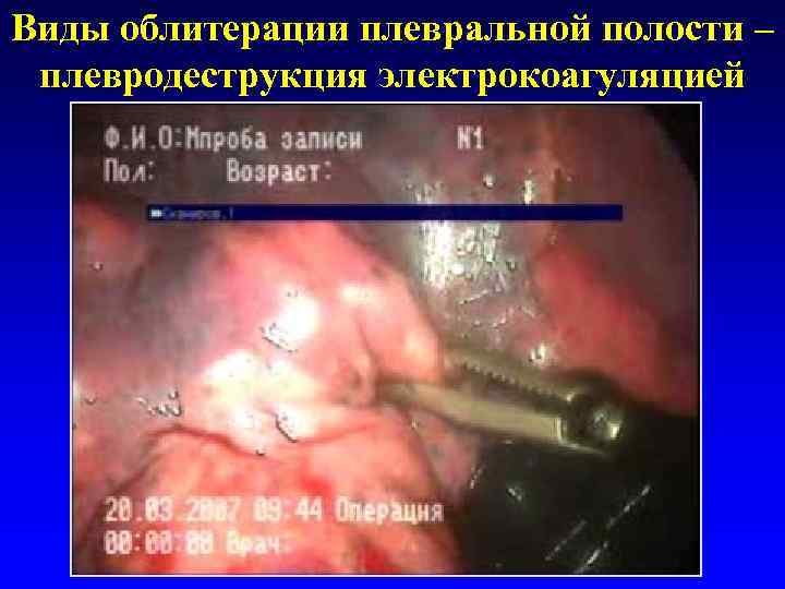 Виды облитерации плевральной полости – плевродеструкция электрокоагуляцией 