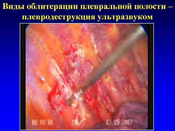 Виды облитерации плевральной полости – плевродеструкция ультразвуком 