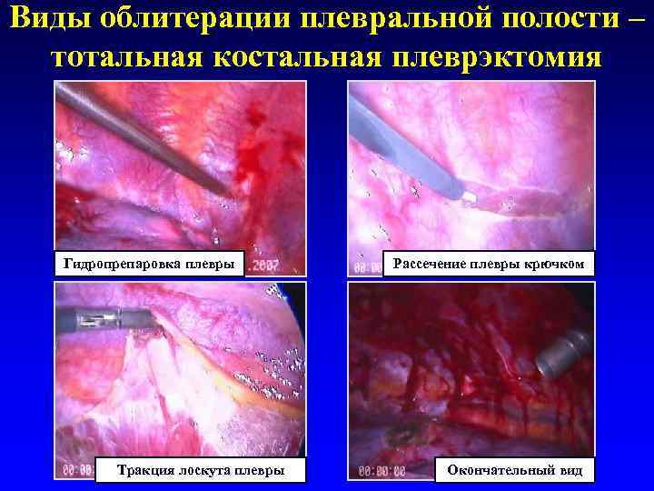 Виды облитерации плевральной полости –  тотальная костальная плеврэктомия  Гидропрепаровка плевры  