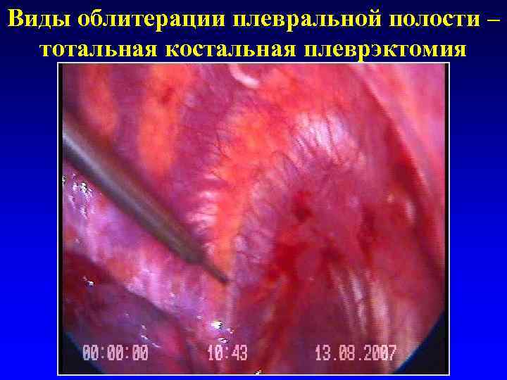 Виды облитерации плевральной полости –  тотальная костальная плеврэктомия 