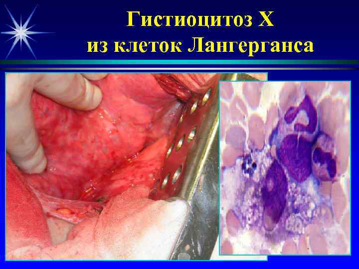   Гистиоцитоз Х из клеток Лангерганса 