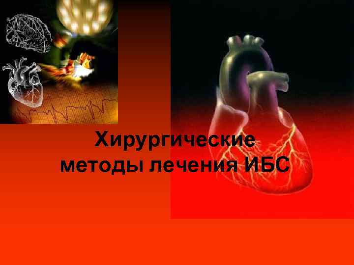   Хирургические методы лечения ИБС 