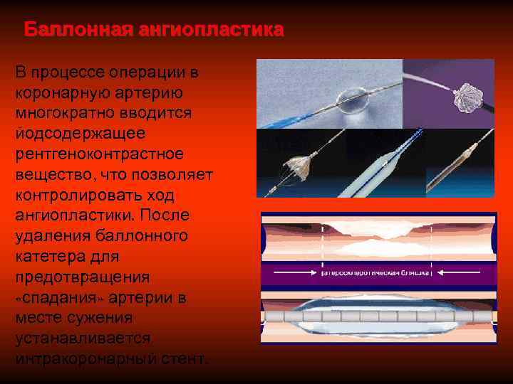 Баллонная ангиопластика В процессе операции в коронарную артерию многократно вводится йодсодержащее рентгеноконтрастное вещество, что