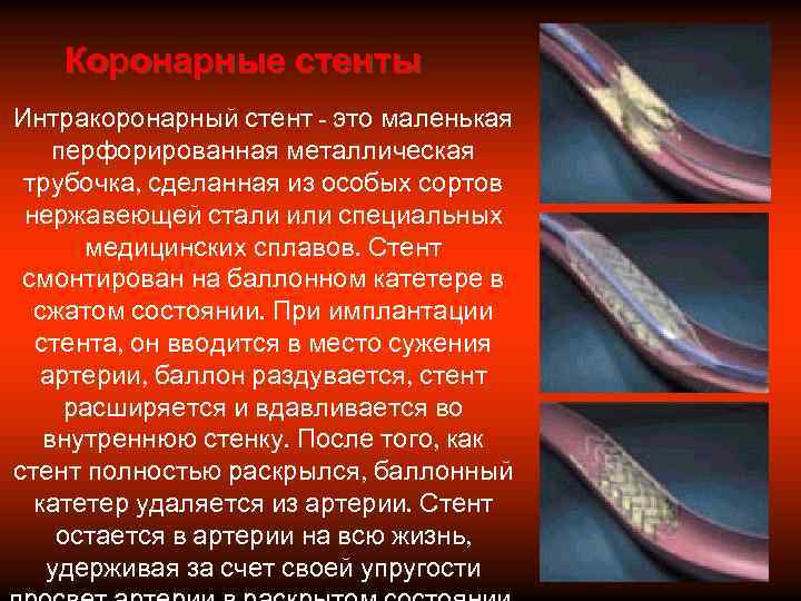   Коронарные стенты Интракоронарный стент - это маленькая перфорированная металлическая трубочка, сделанная из