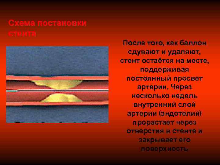 Схема постановки стента     После того, как баллон   