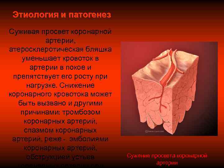  Этиология и патогенез Суживая просвет коронарной  артерии, атеросклеротическая бляшка уменьшает кровоток в
