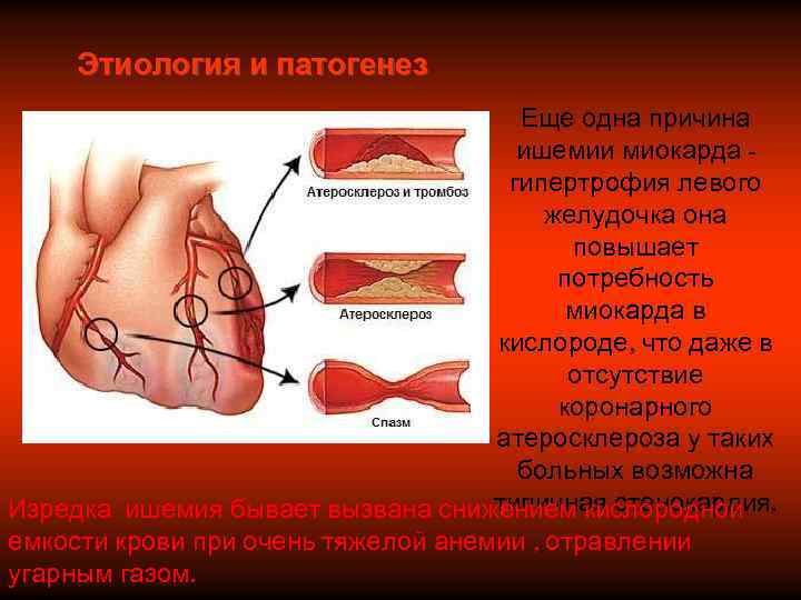  Этиология и патогенез    Еще одна причина    ишемии