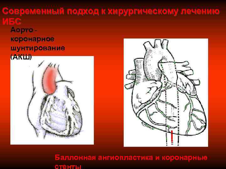 Современный подход к хирургическому лечению ИБС Аорто - коронарное шунтирование (АКШ)   
