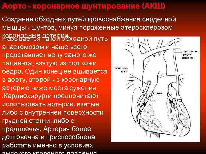 Аорто - коронарное шунтирование (АКШ) Создание обходных путей кровоснабжения сердечной мышцы - шунтов, минуя