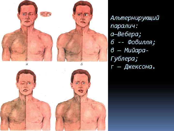 Альтернирующий паралич: а—Вебера; б -- Фовилля; в — Мийара- Гублера; г — Джексона. 