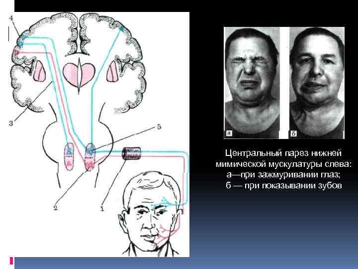 Лицевой нерв слева. Центральный парез 7 пары ЧМН. Парез мимической мускулатуры лицевого нерва. Периферический парез лицевого нерва. Паралич лицевого нерва неврология.