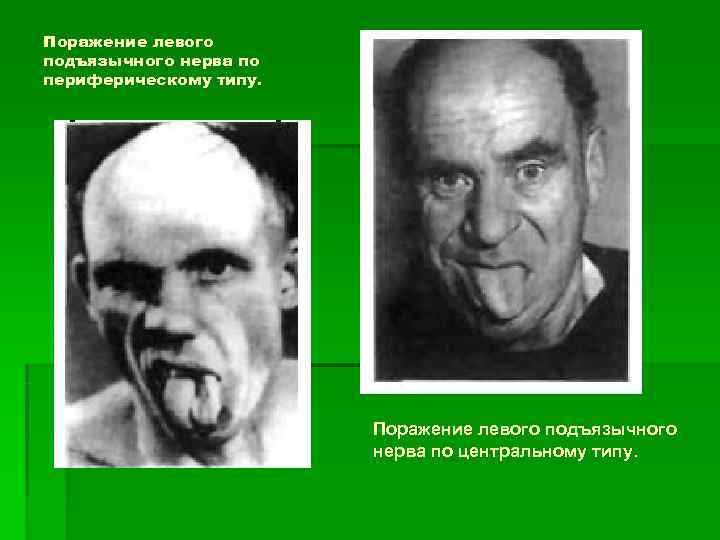 Поражение левого подъязычного нерва по периферическому типу.     Поражение левого подъязычного