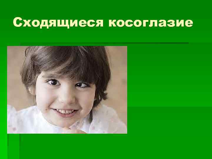 Сходящиеся косоглазие 