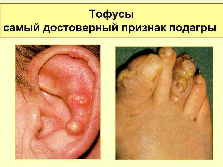    Тофусы самый достоверный признак подагры 