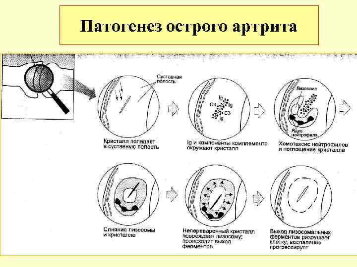 Подагра схема патогенеза