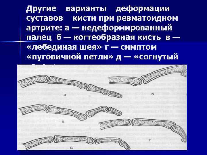 Другие варианты деформации суставов кисти при ревматоидном артрите: а — недеформированный палец б —