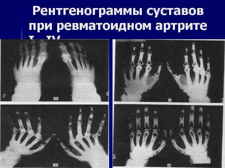 Рентгенограммы суставов при ревматоидном артрите I—IV 