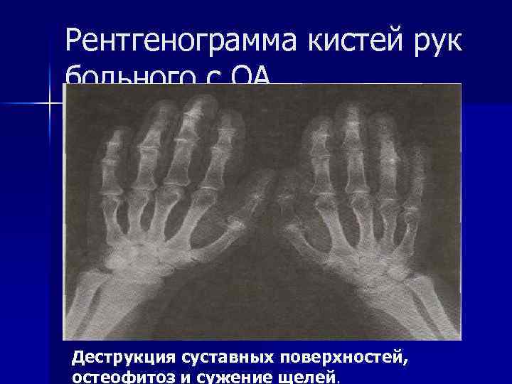 Рентгенограмма кистей рук больного с ОА Деструкция суставных поверхностей, остеофитоз и сужение щелей. 