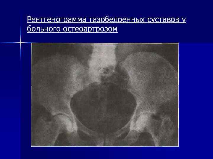 Рентгенограмма тазобедренных суставов у больного остеоартрозом 