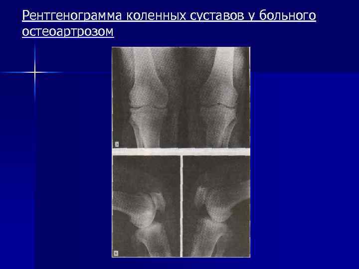 Рентгенограмма коленных суставов у больного остеоартрозом 