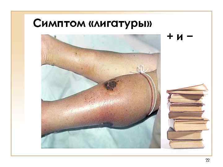 Симптом «лигатуры»    +и−      22 