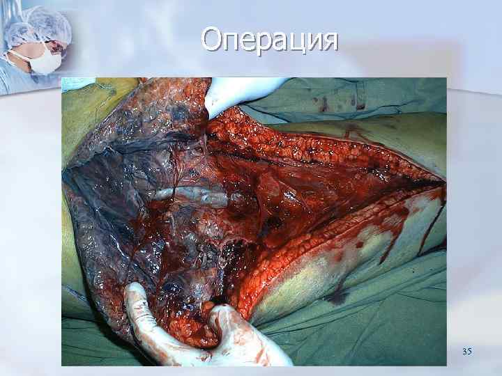 Операция    35 