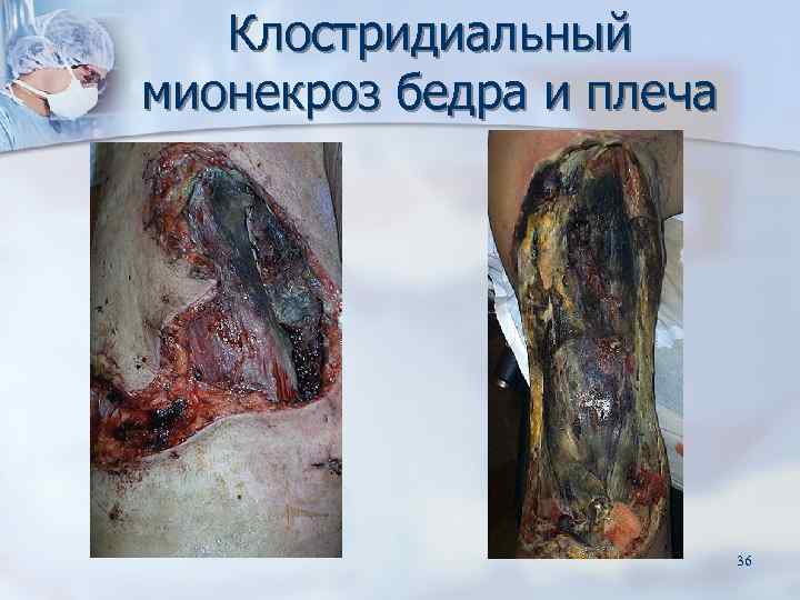   Клостридиальный мионекроз бедра и плеча      36 