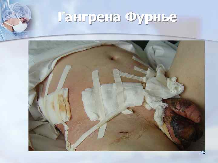 Гангрена Фурнье    42 