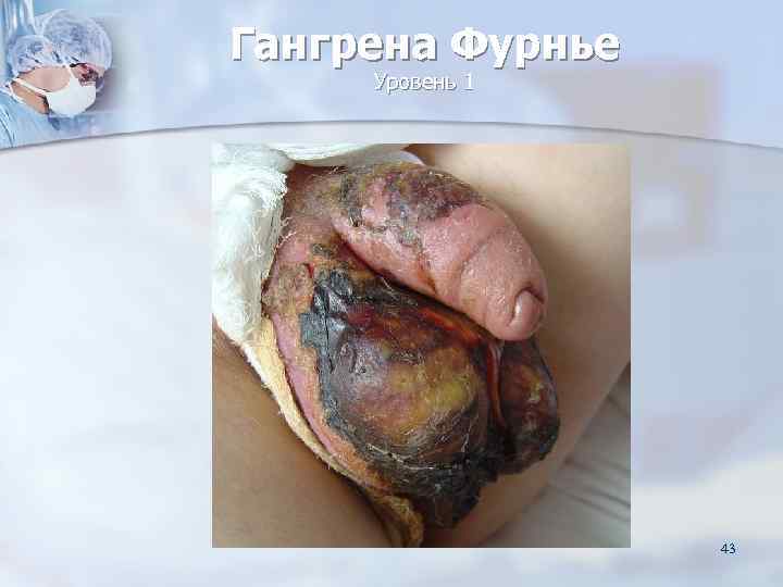 Гангрена Фурнье Уровень 1    43 