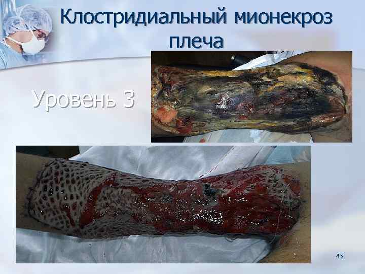  Клостридиальный мионекроз   плеча Уровень 3      45