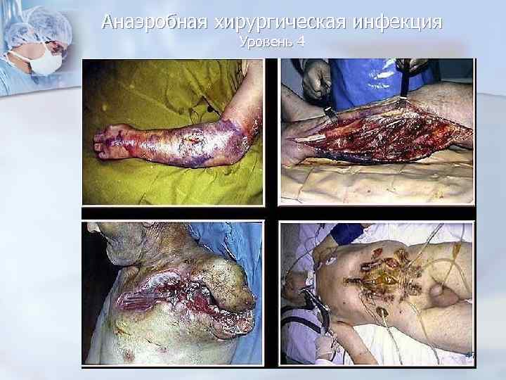 Анаэробная хирургическая инфекция   Уровень 4       47