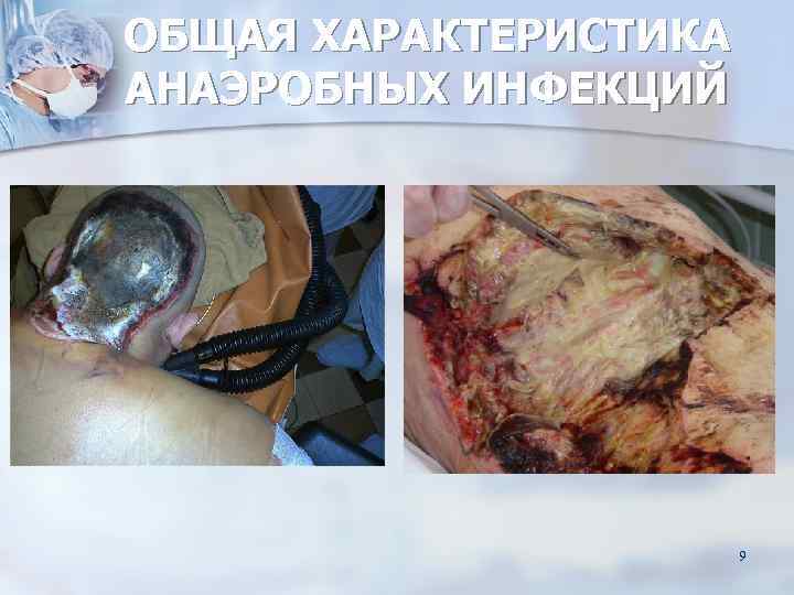 ОБЩАЯ ХАРАКТЕРИСТИКА АНАЭРОБНЫХ ИНФЕКЦИЙ      9 