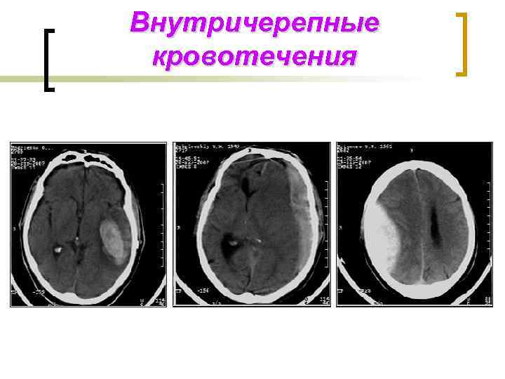 Внутричерепные кровотечения 