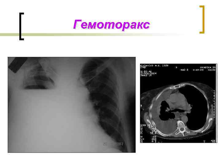 Гемоторакс 