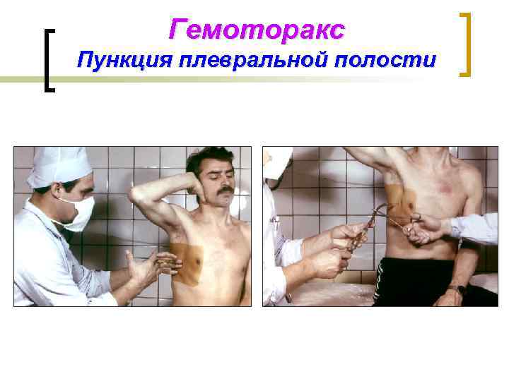 Гемоторакс Пункция плевральной полости 