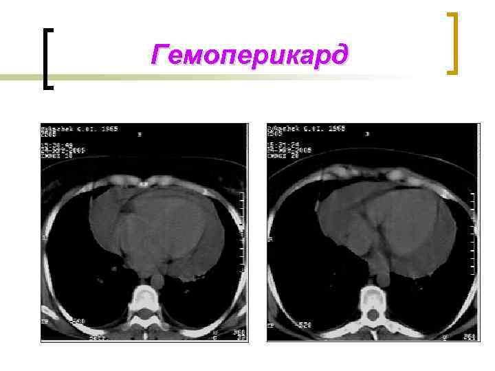 Гемоперикард 