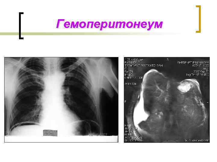 Гемоперитонеум 
