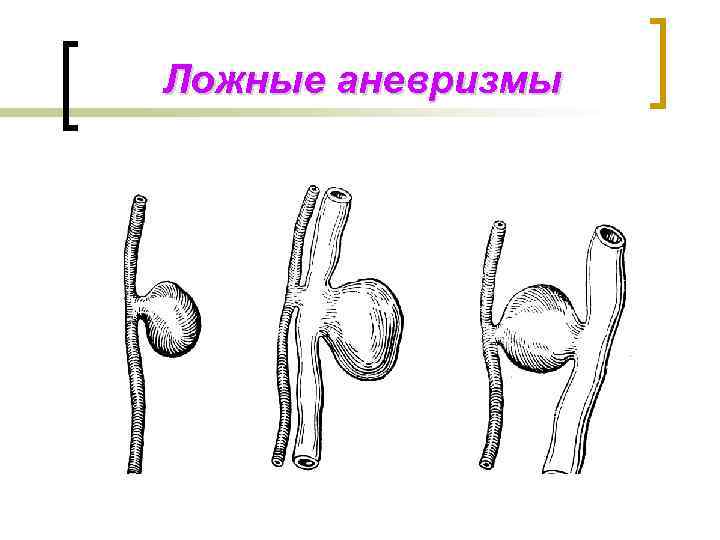 Ложные аневризмы 
