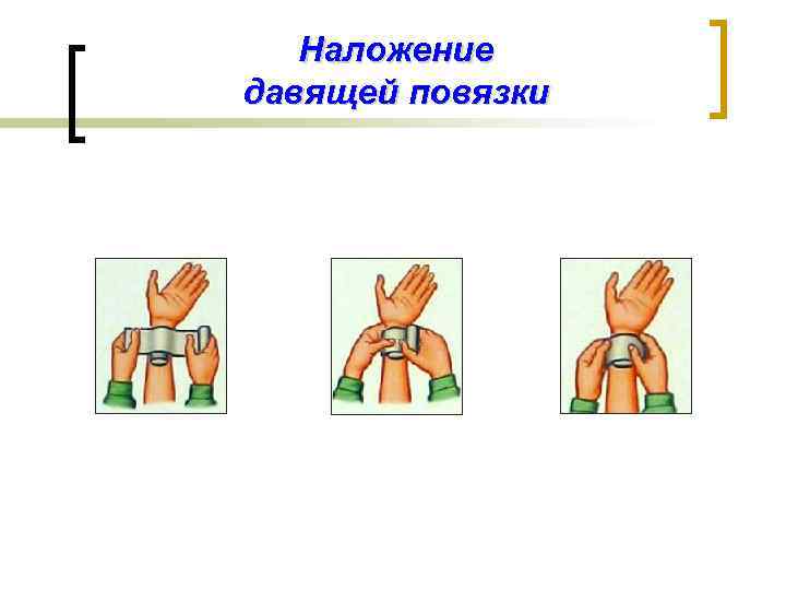 Наложение давящей повязки 