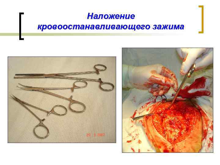 Наложение кровоостанавливающего зажима 