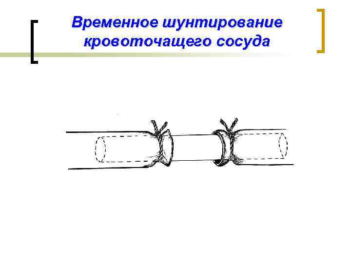 Бесшовное соединение сосудов метод а г коневского. Временное шунтирование. Временное шунтирование сосуда при кровотечении. Временное протезирование сосуда.