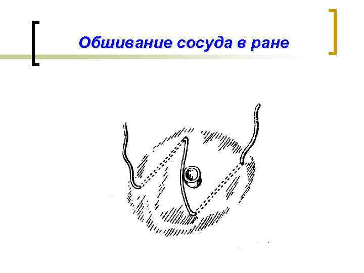 Обшивание сосуда в ране 