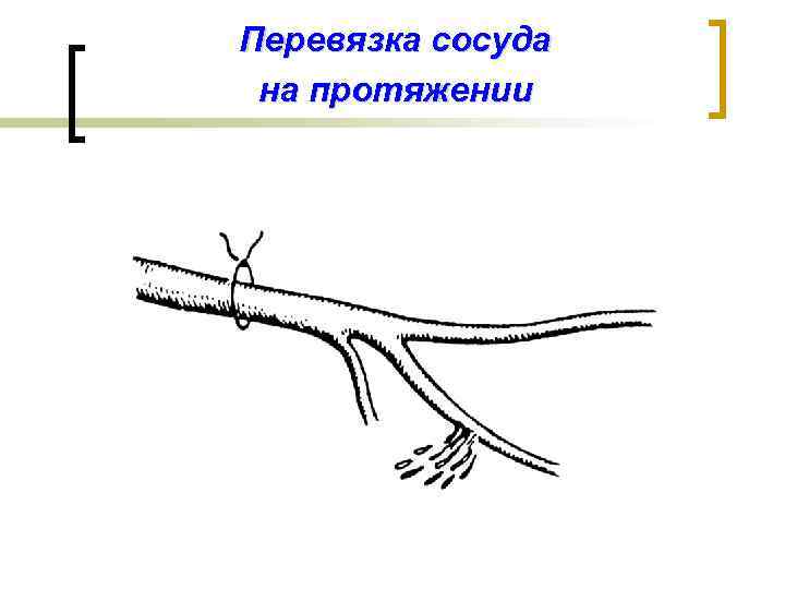 Перевязка сосуда на протяжении 