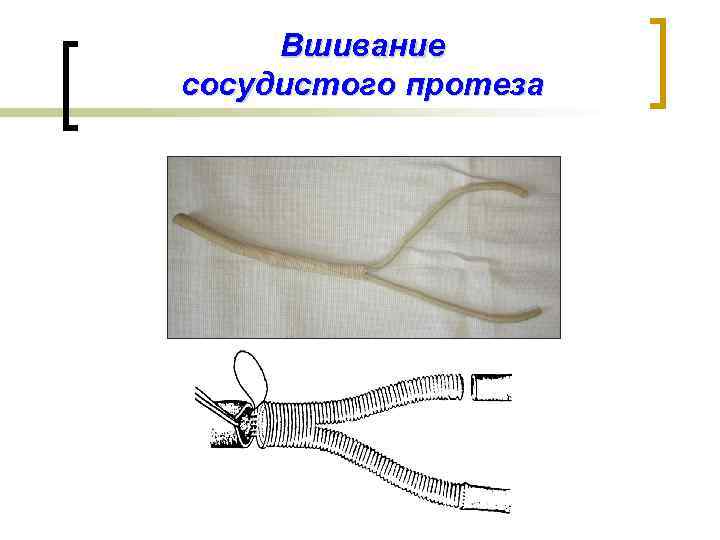 Вшивание сосудистого протеза 