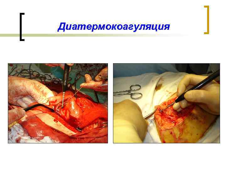 Диатермокоагуляция 