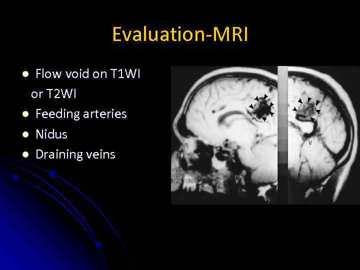 Evaluation-MRI Flow void on T 1 WI or T 2 WI l Feeding arteries