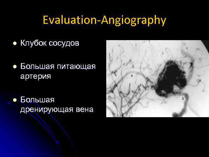 Evaluation-Angiography l Клубок сосудов l Большая питающая артерия l Большая дренирующая вена 