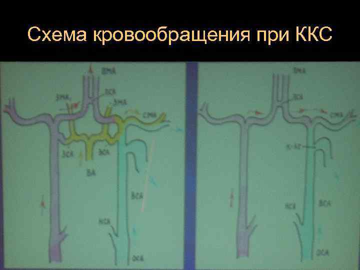 Схема кровообращения при ККС 