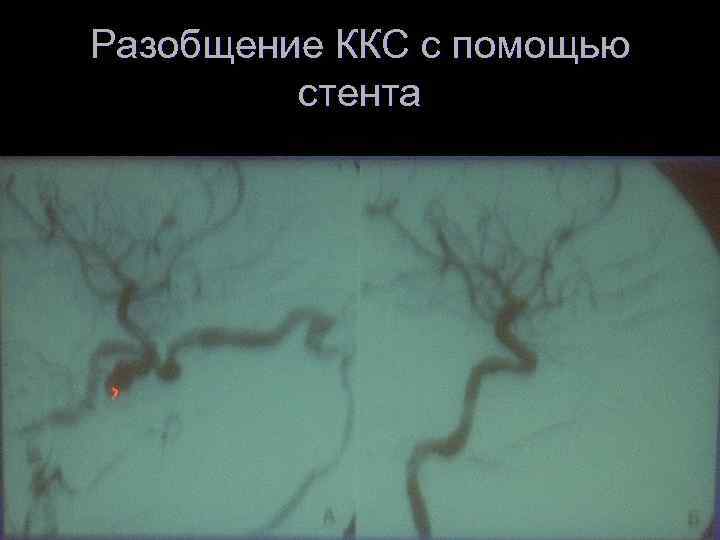 Разобщение ККС с помощью стента 